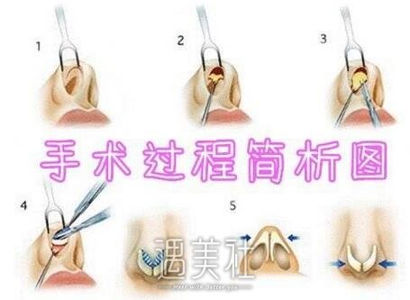 自体肋骨隆鼻
