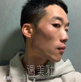 男人隆鼻