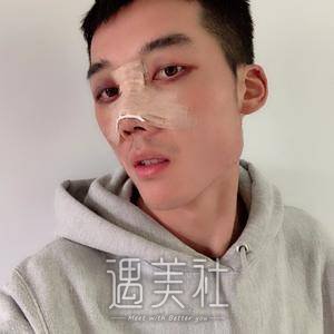 男人隆鼻