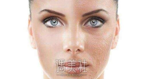 果酸换肤的果