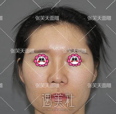 张笑天,颧骨颧弓