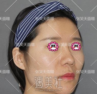张笑天,颧骨颧弓