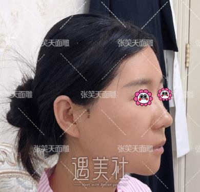 张笑天,颧骨颧弓
