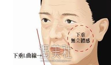 秦皇岛,玻尿酸,注射丰面颊