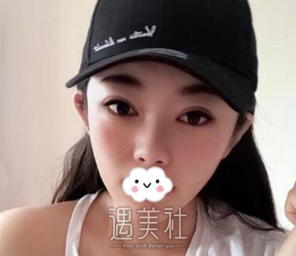 脸部吸脂