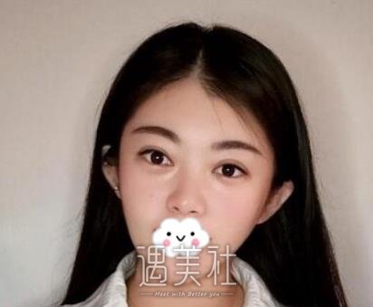 脸部吸脂