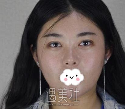 脸部吸脂