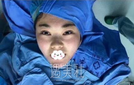 脸部吸脂