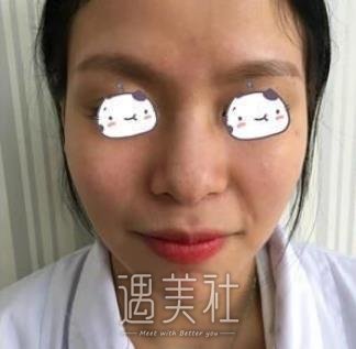 胶原蛋白隆鼻