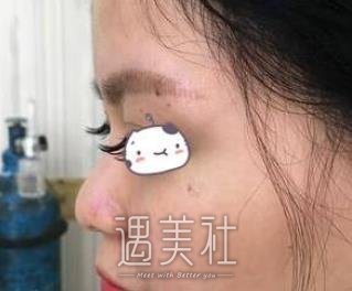 胶原蛋白隆鼻