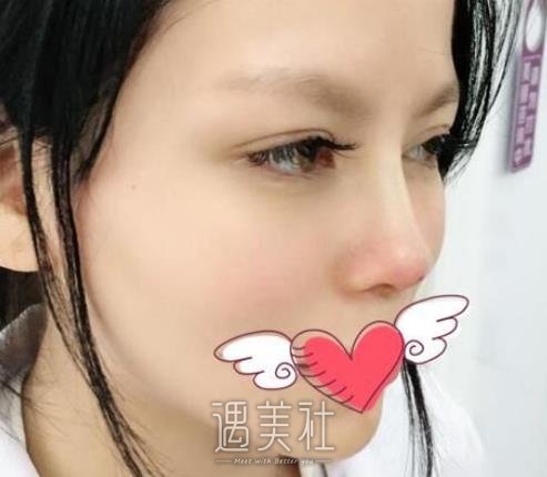 胶原蛋白隆鼻