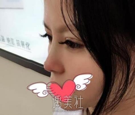 胶原蛋白隆鼻
