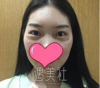 找邹志明医生去了眼袋，现在的眼睛看起来炯炯有神哦~ width=