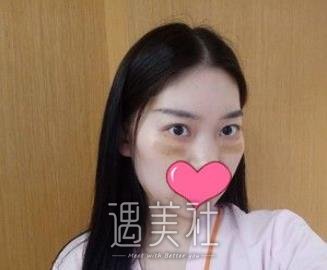 邹志明,去眼袋