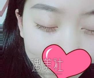 邹志明,去眼袋