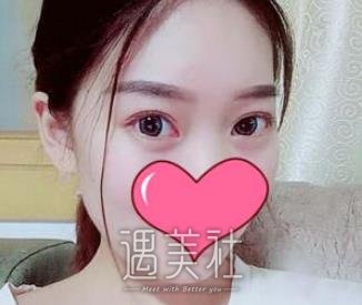 邹志明,去眼袋