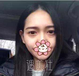 北京,卓彦,祛眼袋