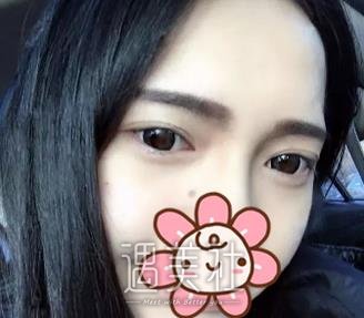 北京,卓彦,祛眼袋