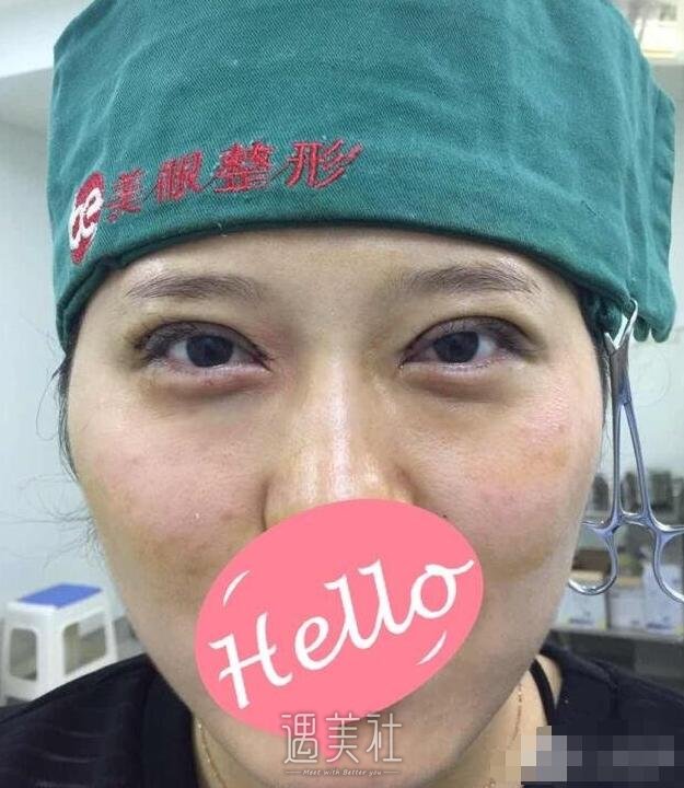 双眼皮宽度6mm恢复后果照片分享|双眼皮宽度6mm案例分享~