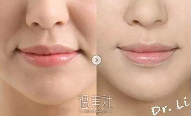 三亚自体脂肪鼻唇沟填充术大约要多少钱?收费标准怎样的?