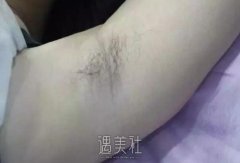 福华整形医院做了脱毛，同事朋友不再嘲笑我是“毛孩子”了~ width=