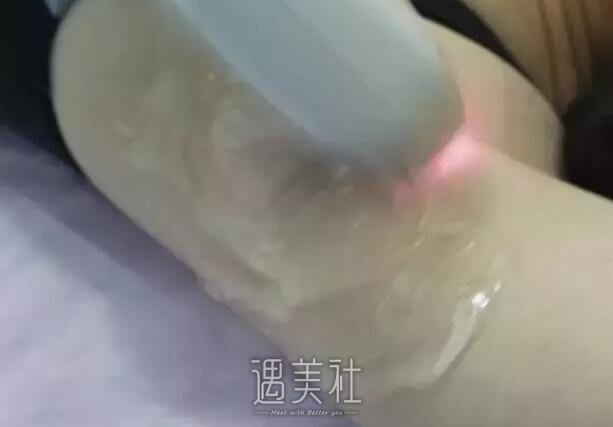 福华整形医院做了脱毛，同事朋友不再嘲笑我是“毛孩子”了~