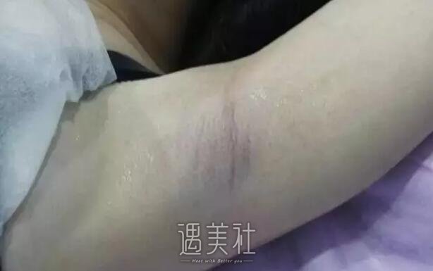 福华整形医院做了脱毛，同事朋友不再嘲笑我是“毛孩子”了~
