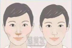 磨颧骨有后遗症吗?怎么护理能有减少磨颧骨后遗症呢? width=