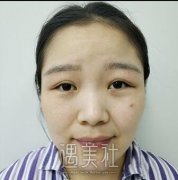 武汉金国华双眼皮修复案例：金医生的好口碑货真价实啊~ width=