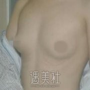 隆胸手术专家罗盛康医生怎么样?有他近期的丰胸案例吗? width=