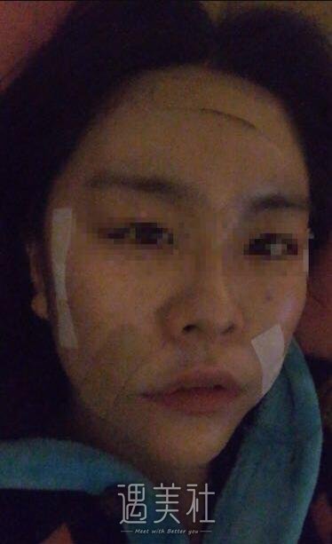 面部填充整形案例a