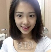 邱立东自体脂肪填充隆鼻案例：不排异的优势打动了我~ width=