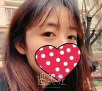 找施悦医生给我做了重睑术，现在恢复果我很满意呢~ width=
