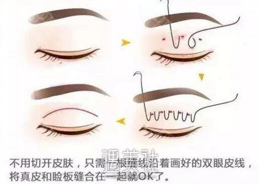 埋线双眼皮好吗
