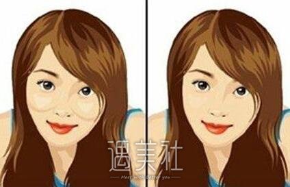 磨颧骨
