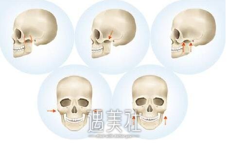 磨颧骨