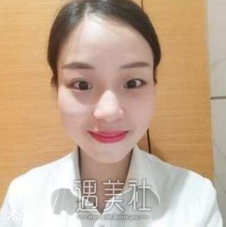 开外眼角前后对比