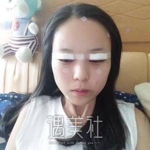 开外眼角前后对比
