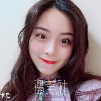 开外眼角前后对比