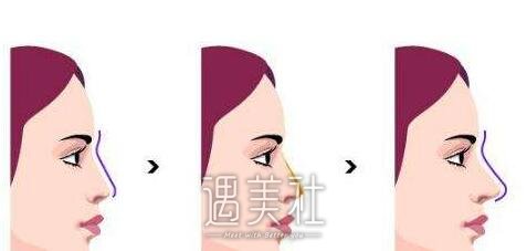 自体脂肪填充隆鼻