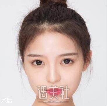 双眼皮修复,金国华