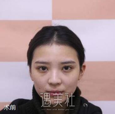 双眼皮修复,金国华