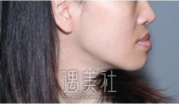 戽斗脸