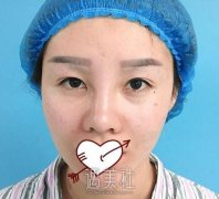 开眼角的果怎么样？这篇开眼角真实案例或许能说明~ width=