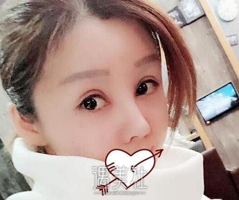 开眼角