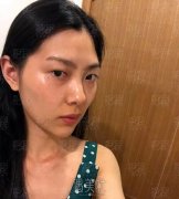 济南伊美尔纳米脂肪混血脸手术案例：妹子亲述新路历程~ width=