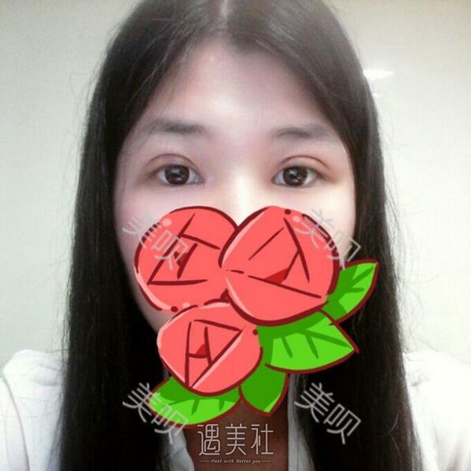 徐学武医生割双眼皮很厉害吗?徐学武双眼皮案例力证哦~