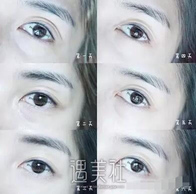 做好的美瞳线图片：半长久纹美瞳线真实案例详细记录哦~