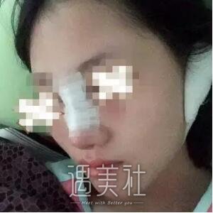 隆鼻尖多久恢复自然?不久前做过隆鼻尖的我有点话想说~
