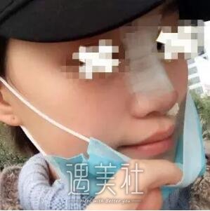 隆鼻尖多久恢复自然?不久前做过隆鼻尖的我有点话想说~